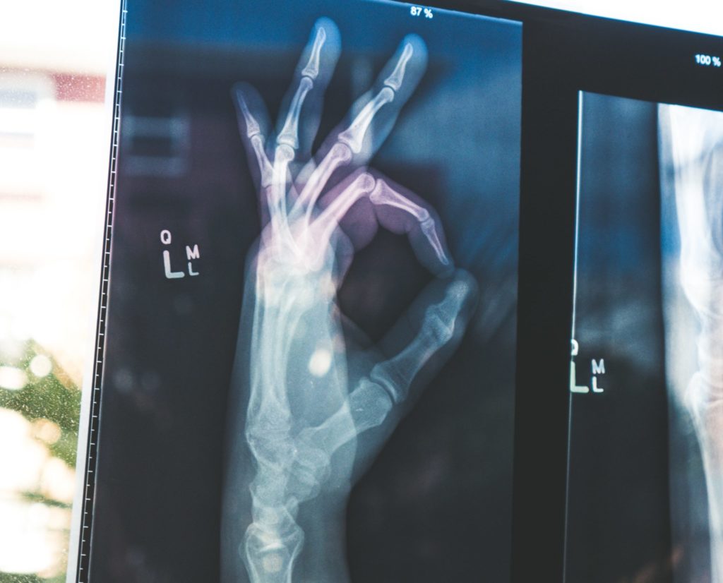 Cómo Lidiar Con Tu Artritis